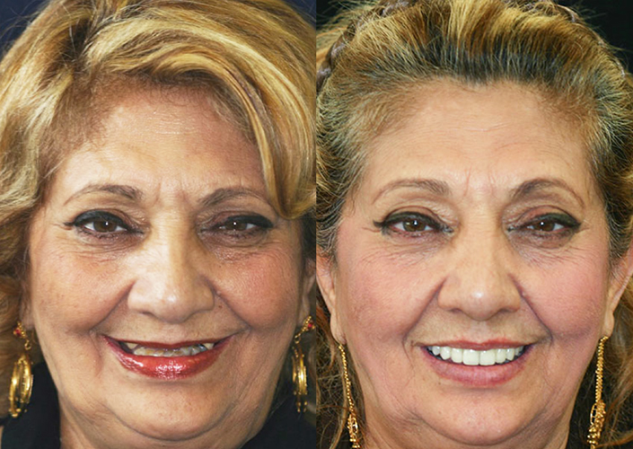 All On 4 Dental Implants - Concord, CA