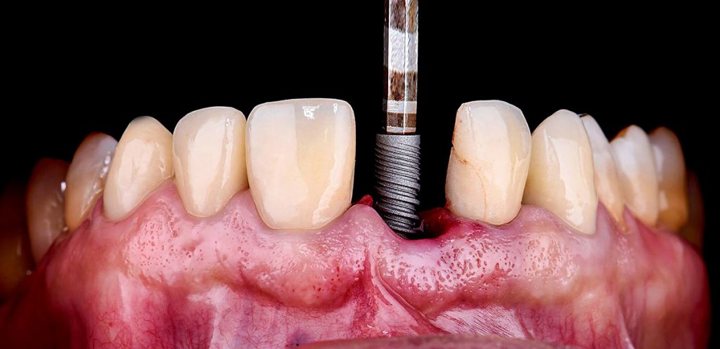 Dental Implant being installed