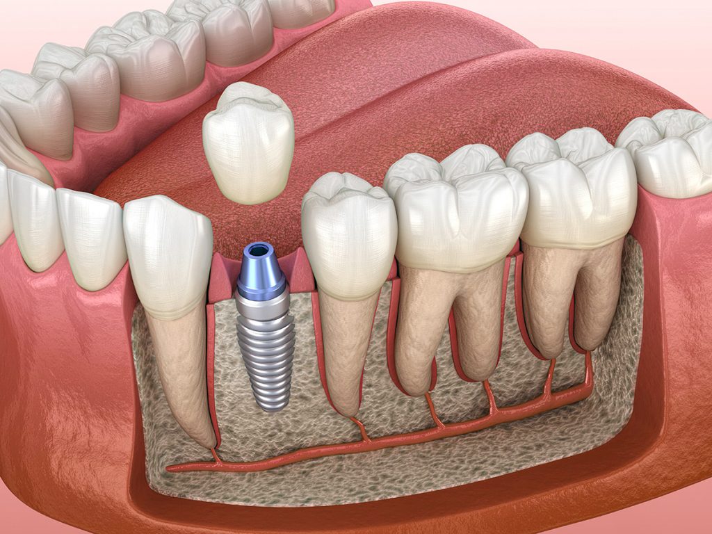 Dental implants stimulate the jaw bone