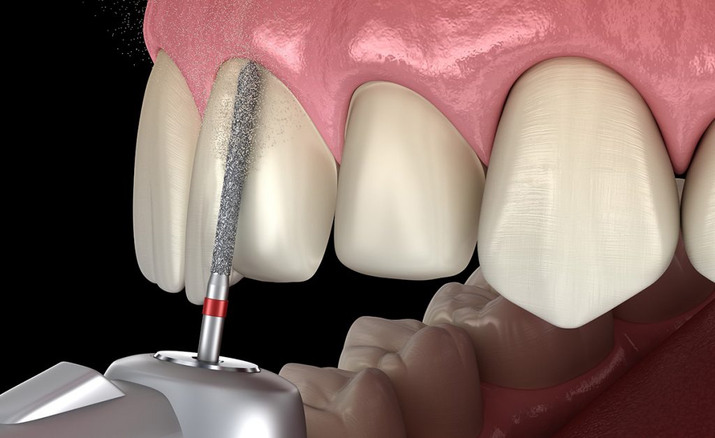 Dental trim of existing teeth