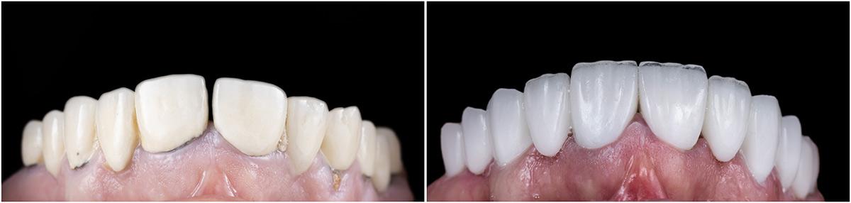 Porcelain Crowns Before and After