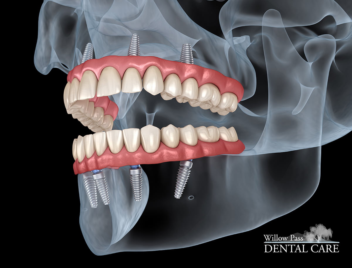 Understanding All On 4 Dental Implants - Willow Pass Dental Care - Concord, CA