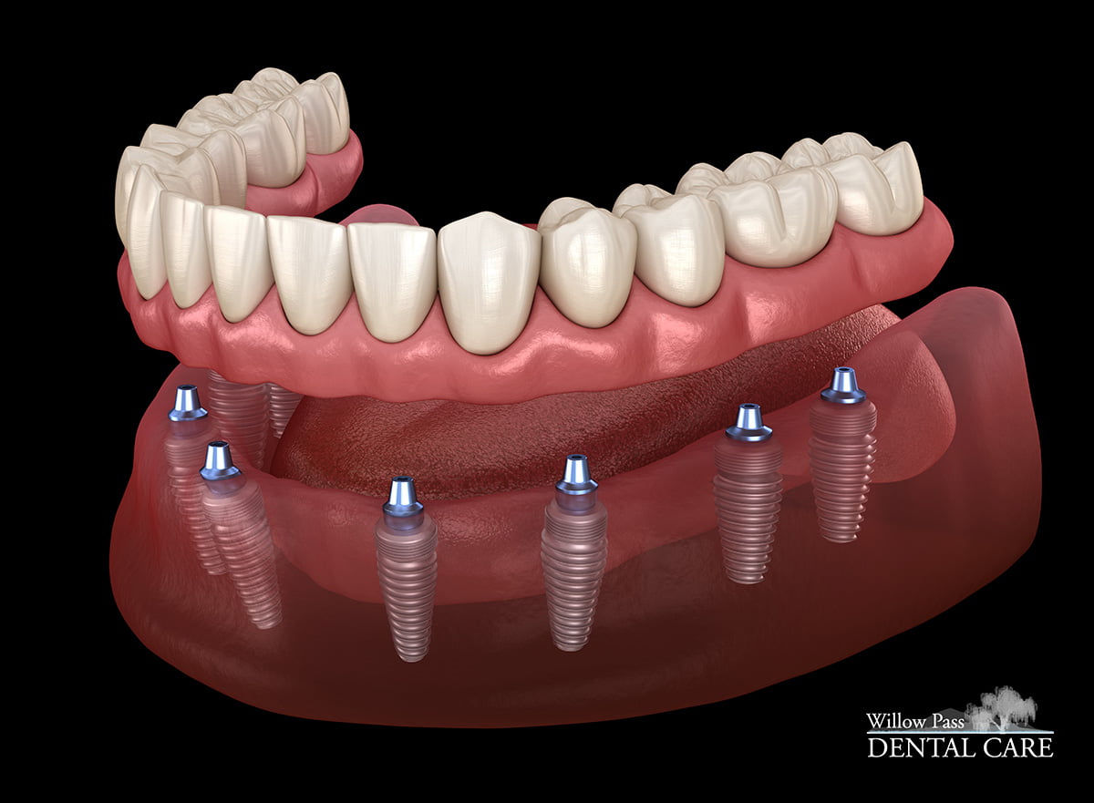 All On 8 Dental Implants - Willow Pass Dental Care - Concord, CA