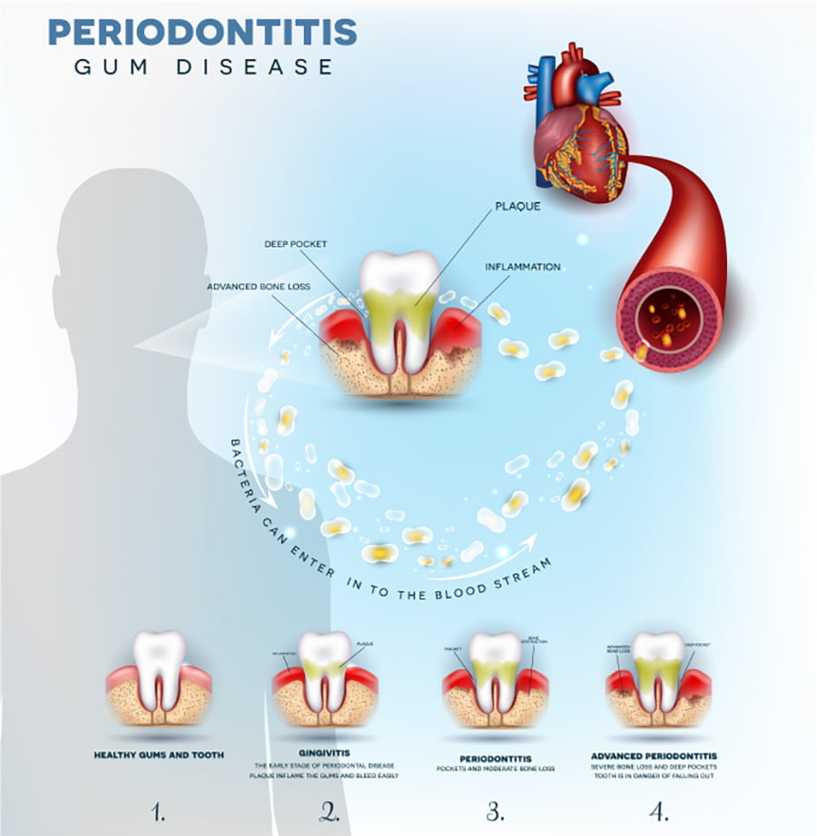 Illustration of Periodontitis - Inflammation of the Gums - Dr. Reza Khazaie, DDS