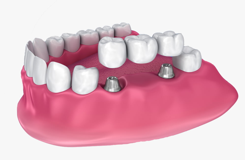 Removable full dentures - Complete - Concord Dentures