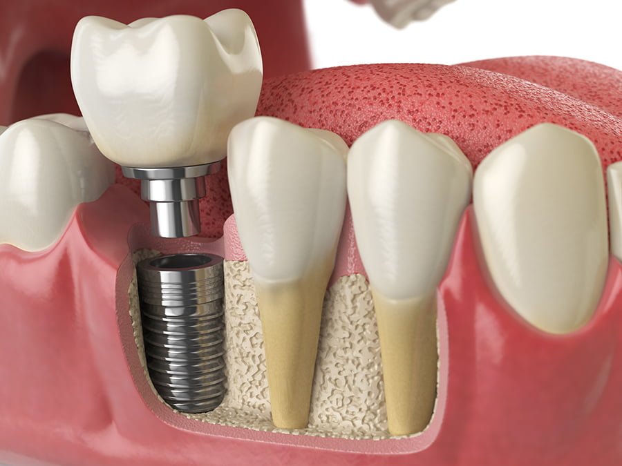 Dental Implants Concord - Advantage #1: Structural