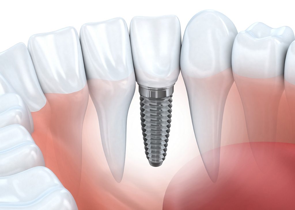 Dental Implants Concord - Willow Pass Dental Care - Concord, CA