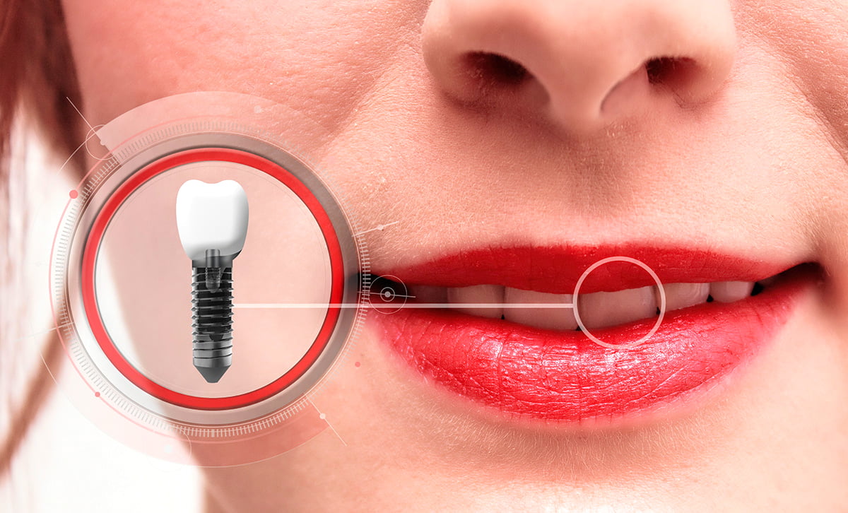 Dental implants Concord - Willow Pass Dental Care, Concord, CA