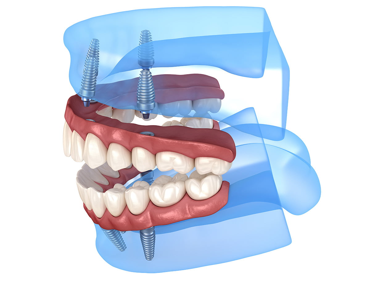 Implant Supported dentures - Willow Pass Dental Care,  Concord, CA