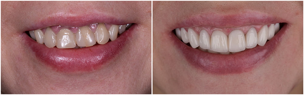 Impresssion-Taking - Concord dentures