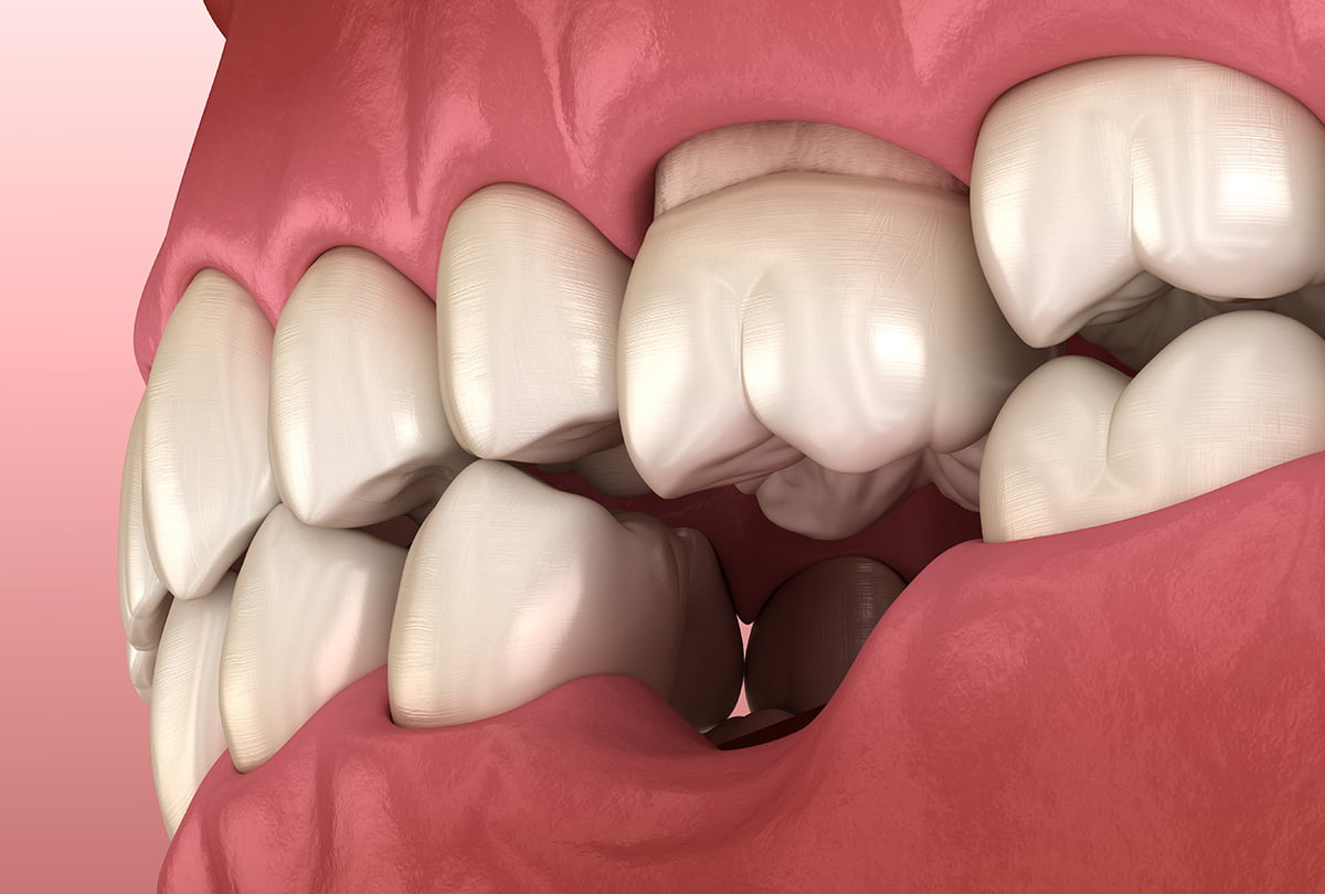 Dental Implants Concord - Advantage #1: Structural
