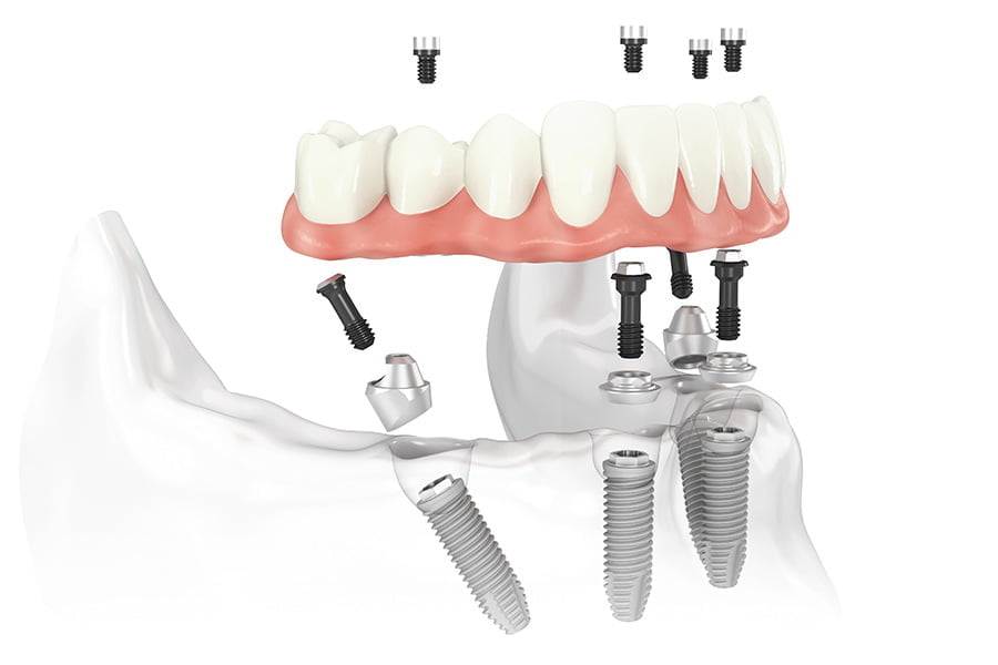 Removable full dentures - Complete - Concord Dentures