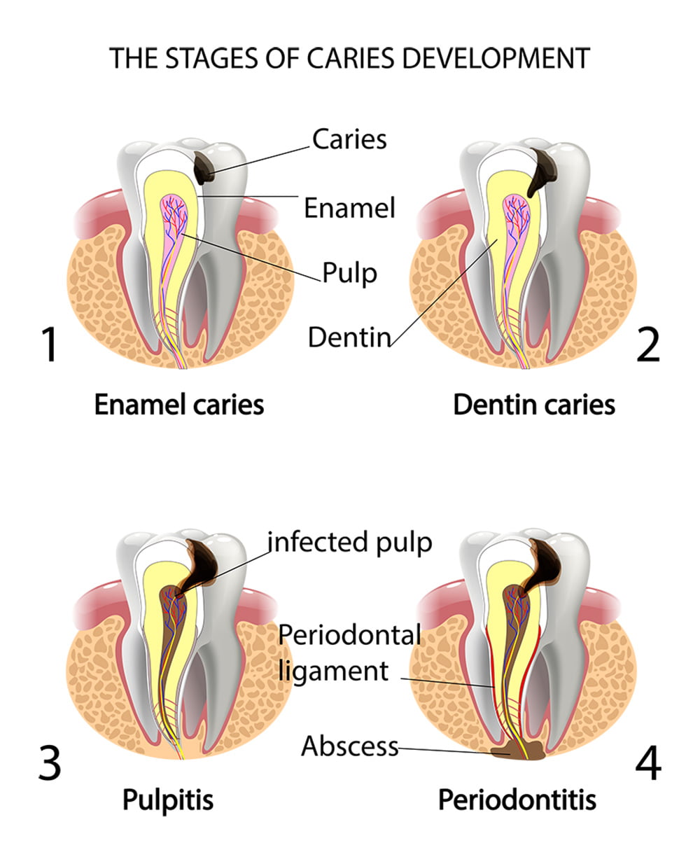 Root canal treatment - Willow Pass Dental Care - Concord, CA
