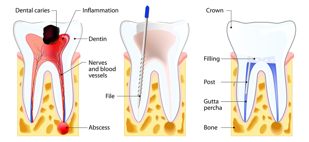 Root canal treatment - Willow Pass Dental Care - Concord, CA