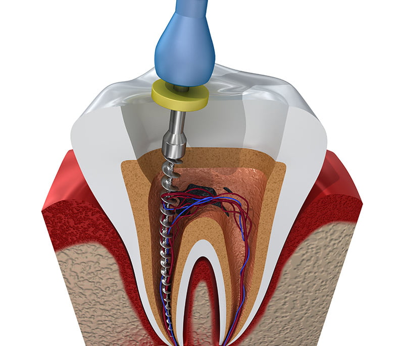 Gingivitis - Dentist Concord CA