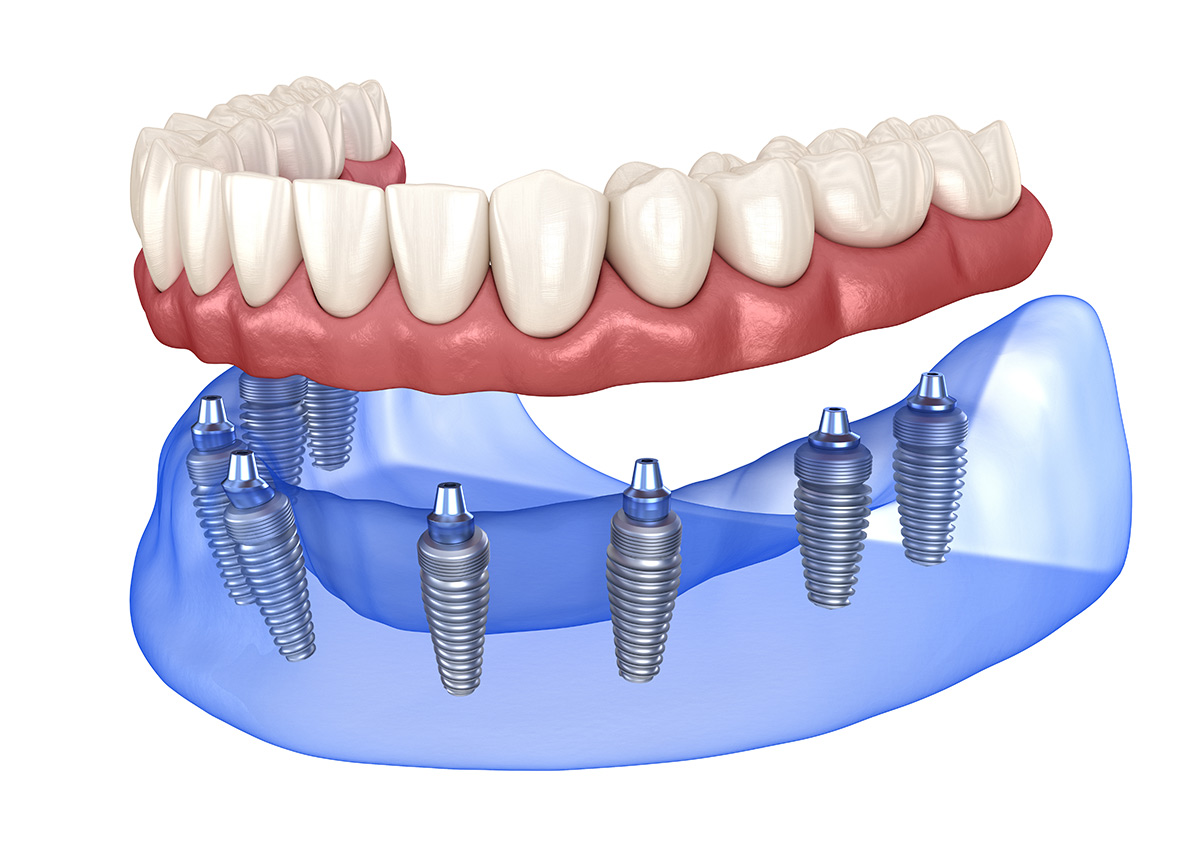 All On X Dental Implants - Willow Pass Dental Care - Concord, CA